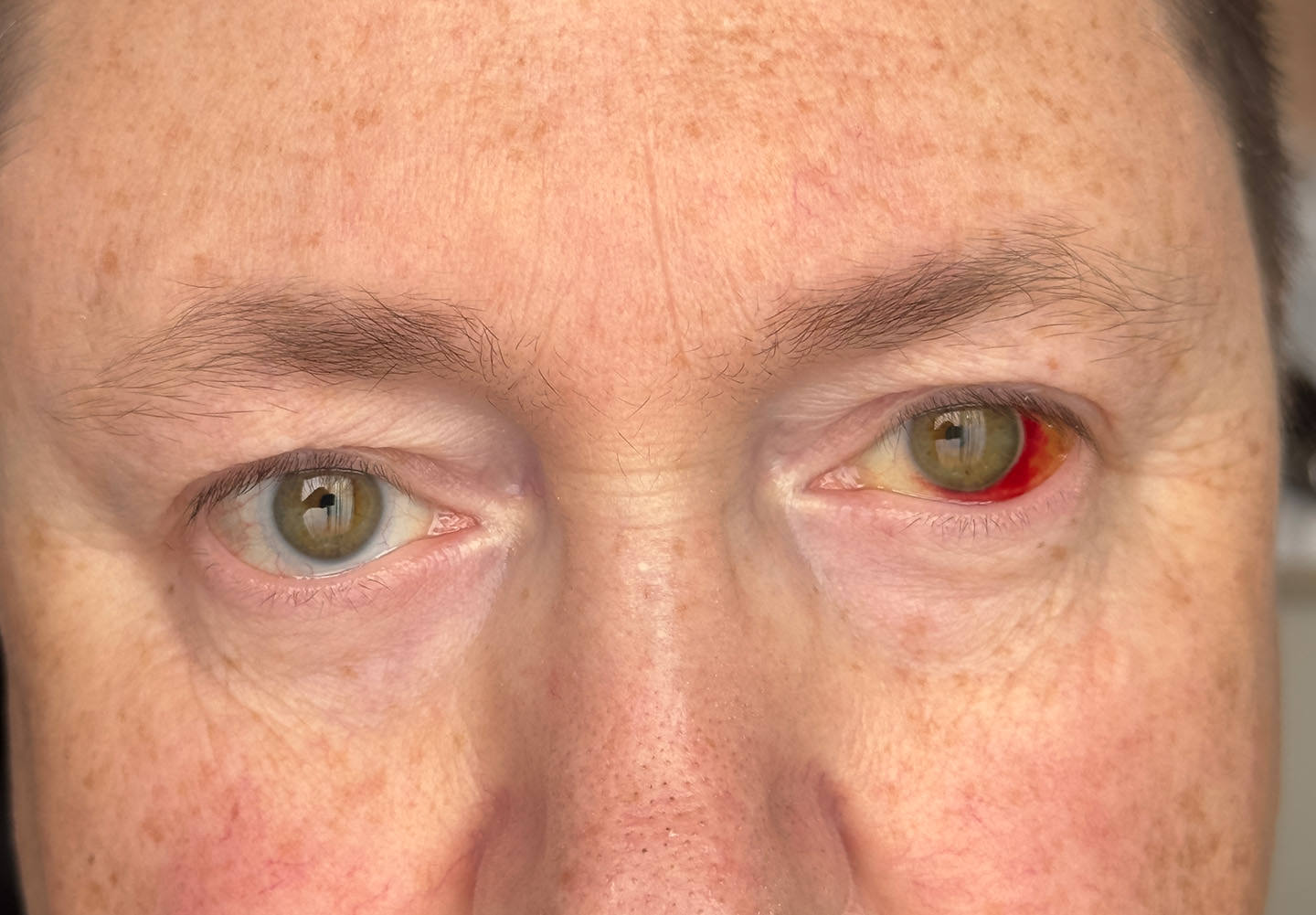 Blood Shot Eye from Cataract Surgery